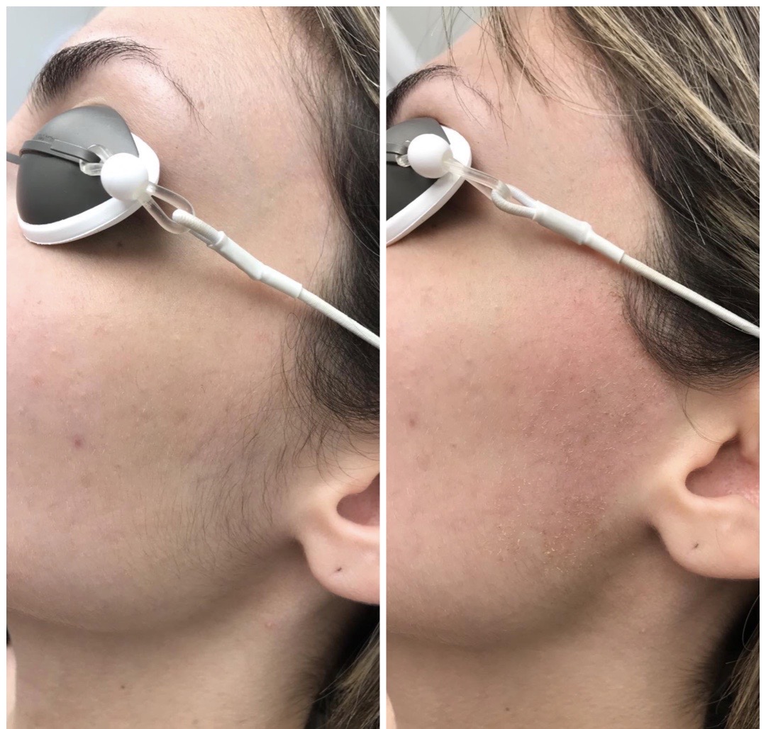 αποτρίχωση με laser Αλεξανδρίτη στο πρόσωπο πριν και μετά